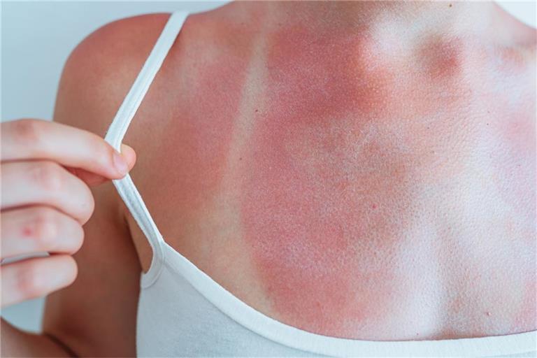 Neben Fieber kann es bei starkem Sonnenbrand auch zu Schüttelfrost kommen. Warum man bei Sonnenbrand friert, erfahren Sie hier.